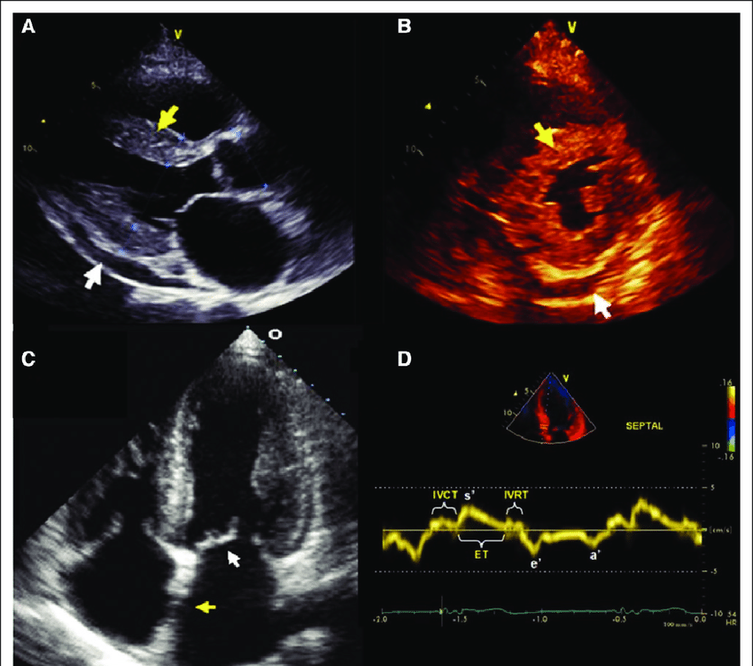 Cardiac Amyloidosis: Key Points